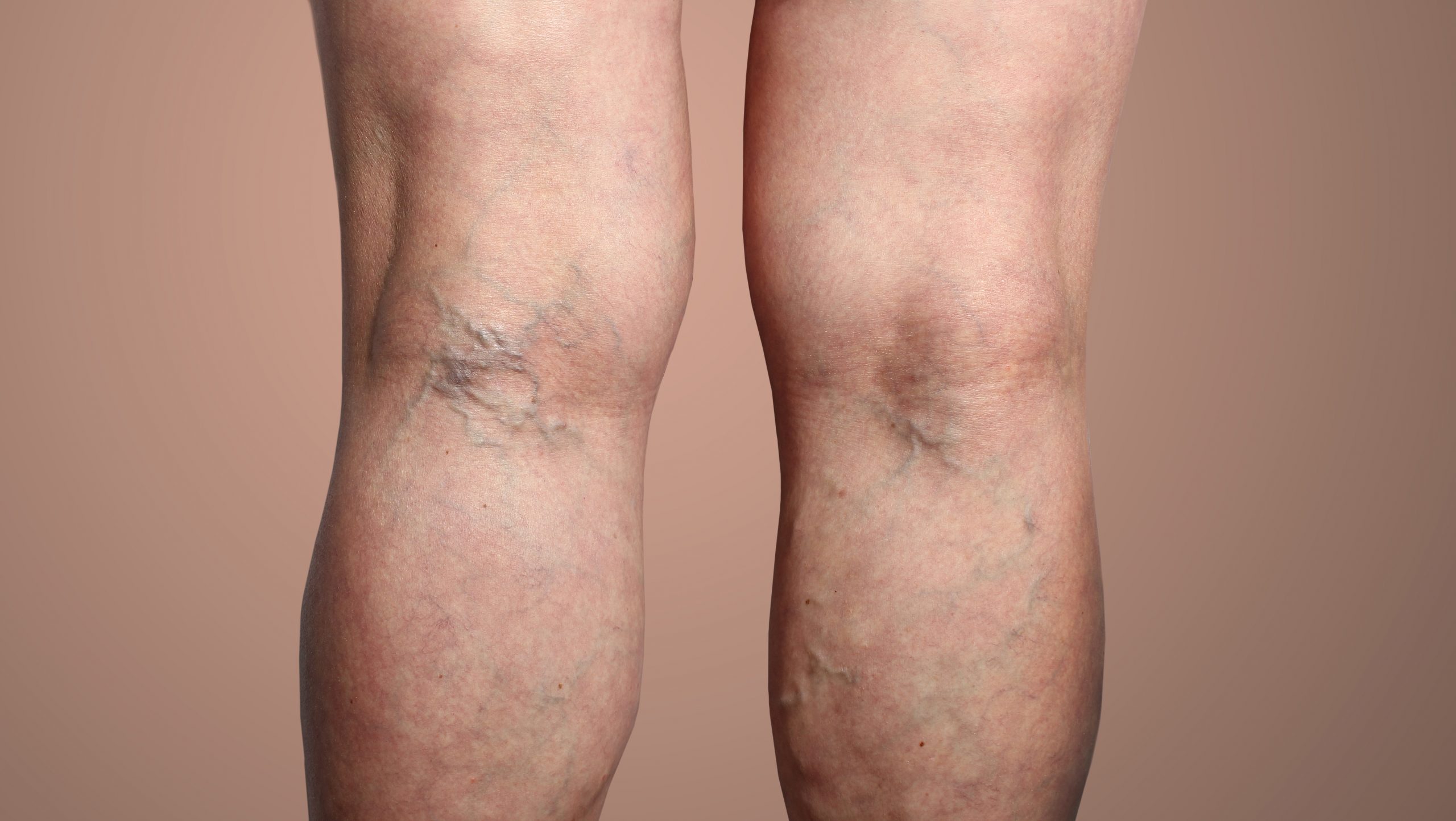 What is the best treatment to get rid of varicose veins? - Prolife